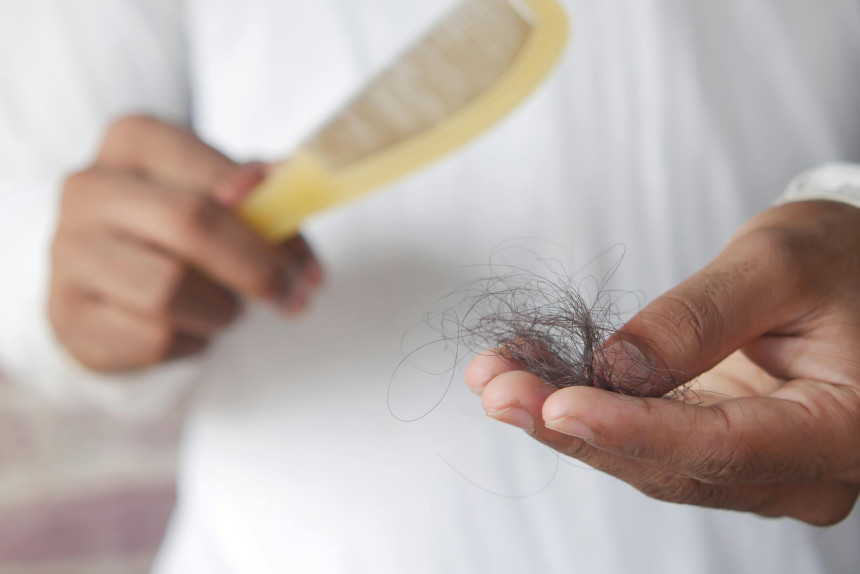 best hairloss treatment clinic in dubai