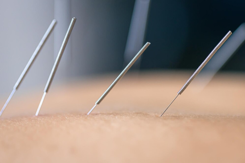 Best Dry Needling Clinics